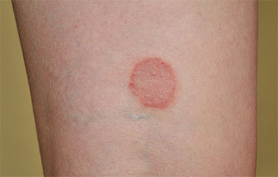 a circular rash on a person's skin
